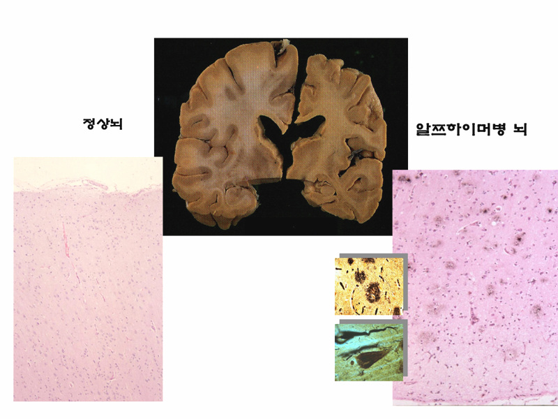 정상뇌 치매뇌 2.jpg