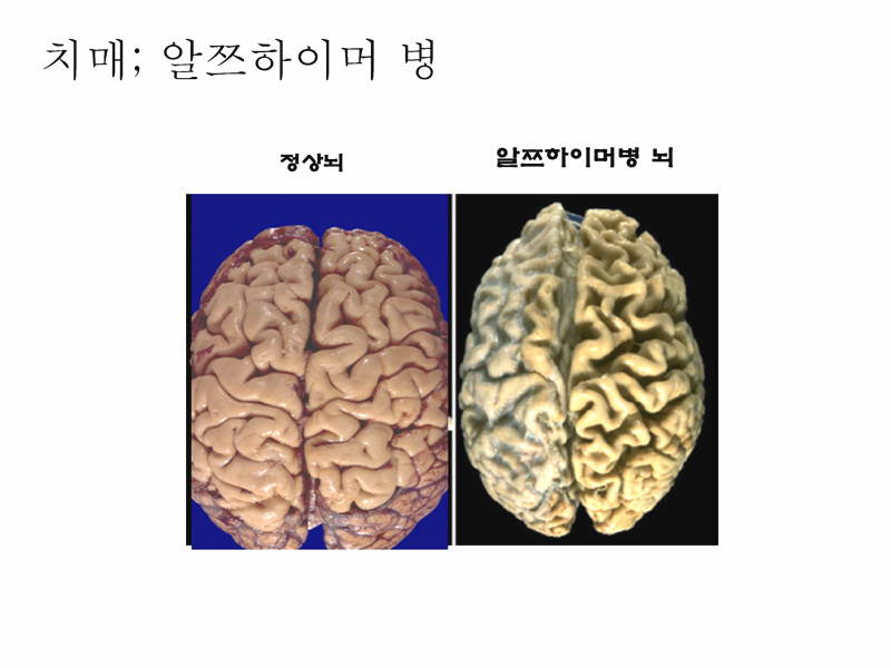 정상뇌 치매뇌.jpg