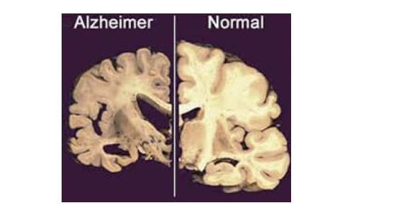 알츠하이머와 정상인의 뇌 모습.jpg